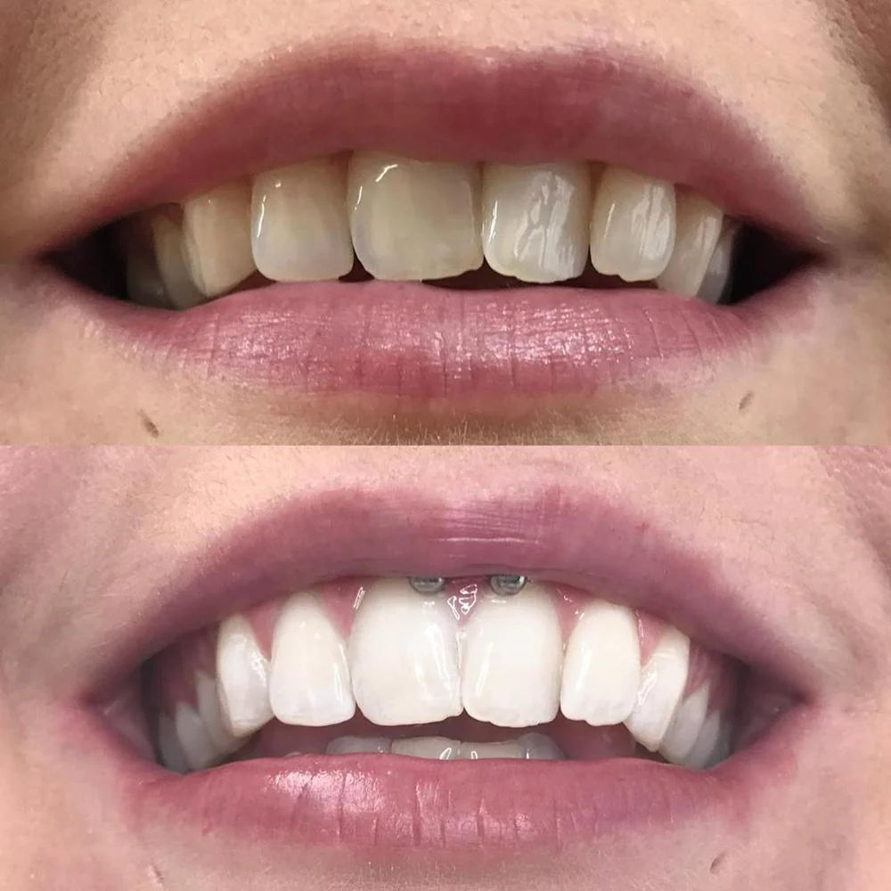 Teeth whitening Color Correction serum