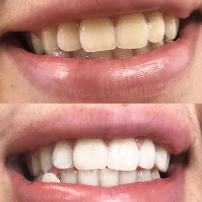 Ensemble Premium de Blanchiment des Dents + Sérum + Bandes de Blanchiment des Dents