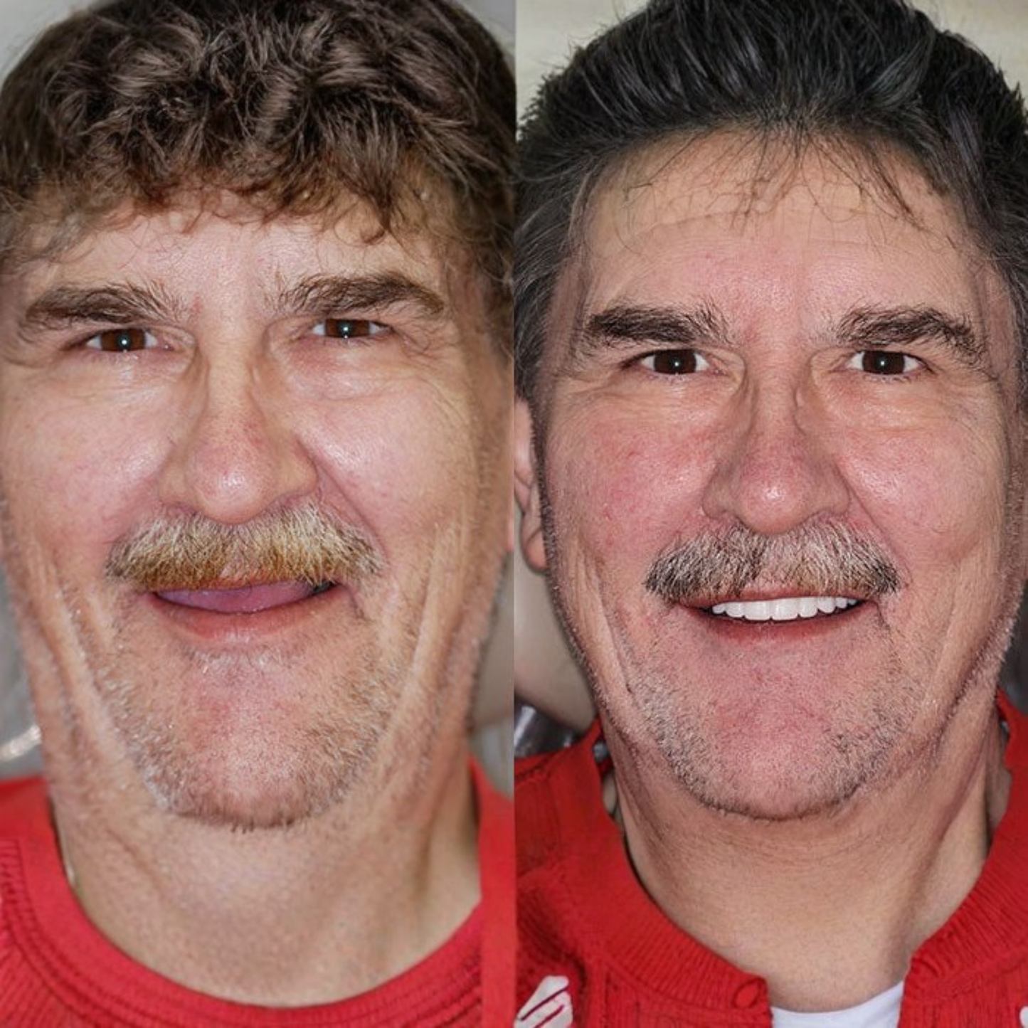 Valcero ProLine op maat gemaakte kunstgebitten