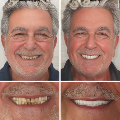 Valcero ProLine op maat gemaakte kunstgebitten