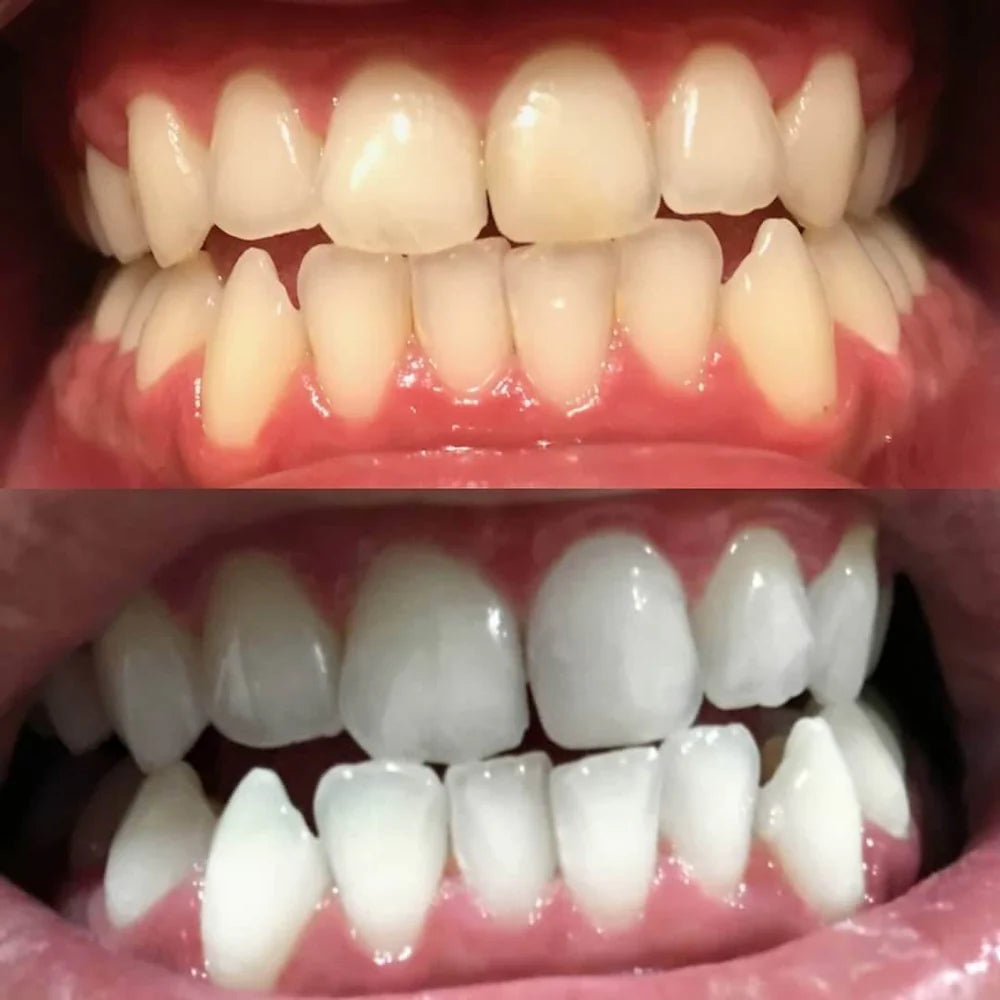 Stylo de blanchiment des dents par correction des couleurs