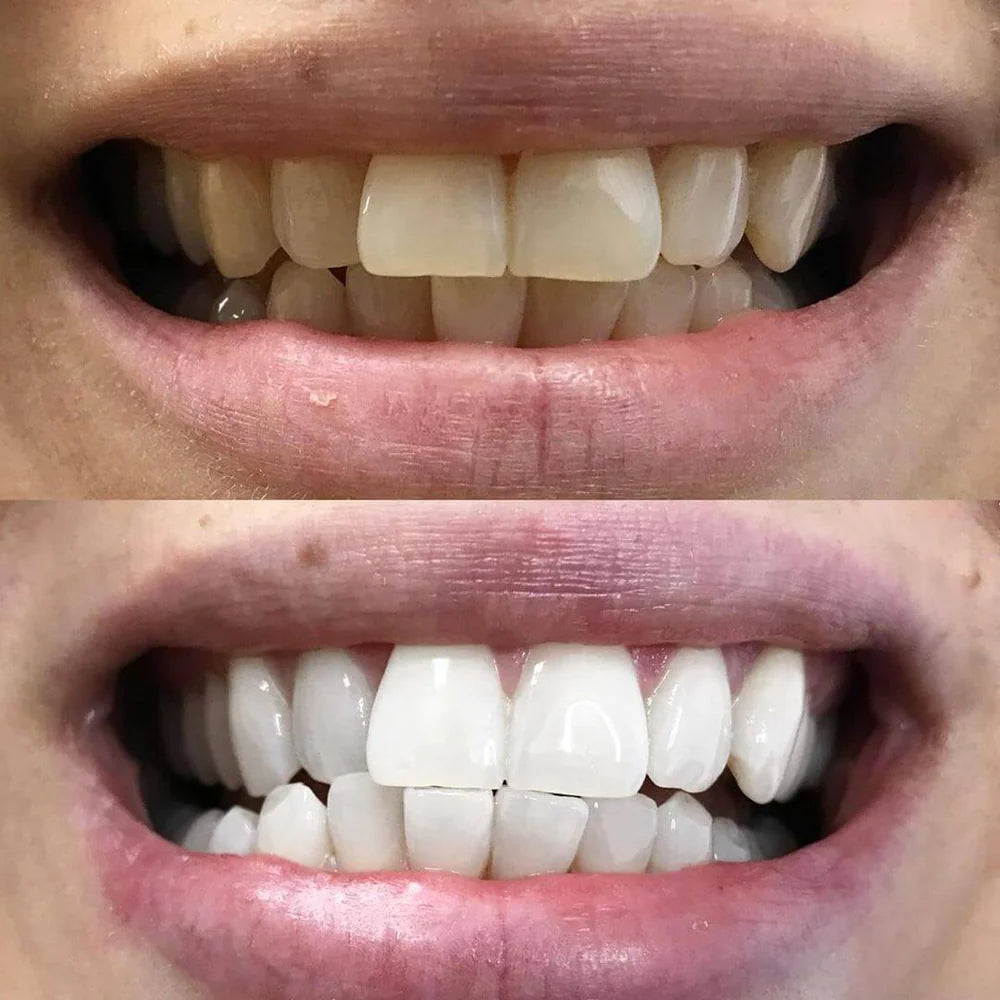 Stylo de blanchiment des dents par correction des couleurs