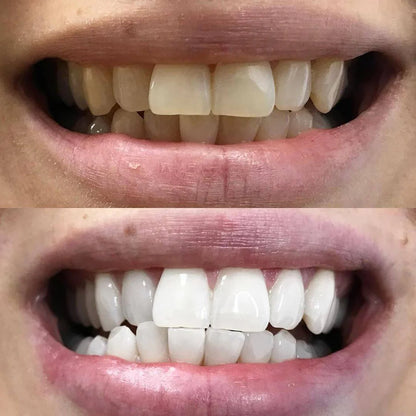 Stylo de blanchiment des dents par correction des couleurs