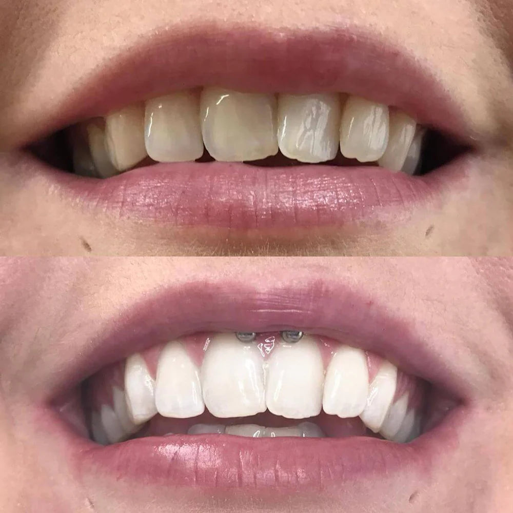 Stylo de blanchiment des dents par correction des couleurs