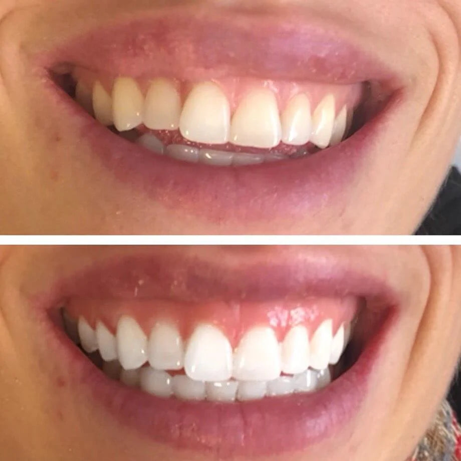 Bandes Blanchissantes pour Dents