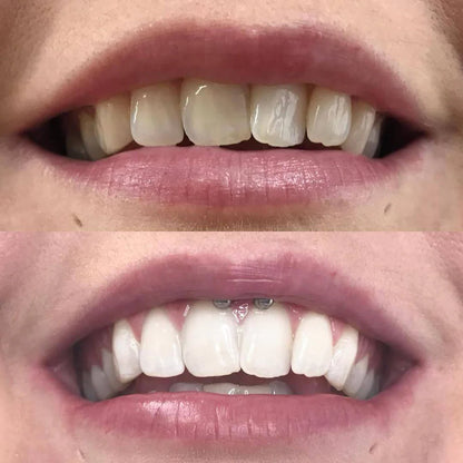 Stylo de blanchiment des dents par correction des couleurs