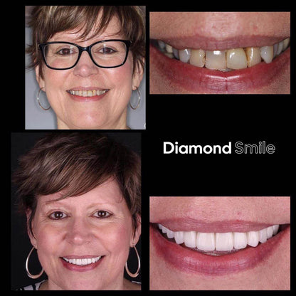 Ensemble Premium de Blanchiment des Dents + Sérum + Bandes de Blanchiment des Dents