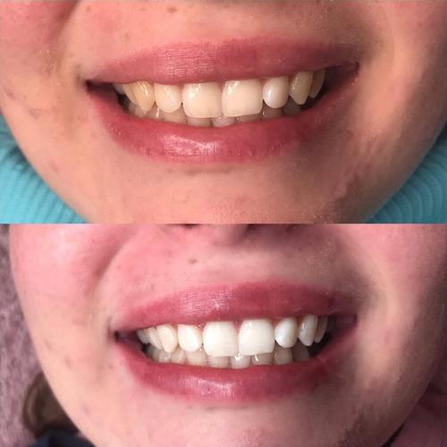 Ensemble Premium de Blanchiment des Dents + Sérum + Bandes de Blanchiment des Dents