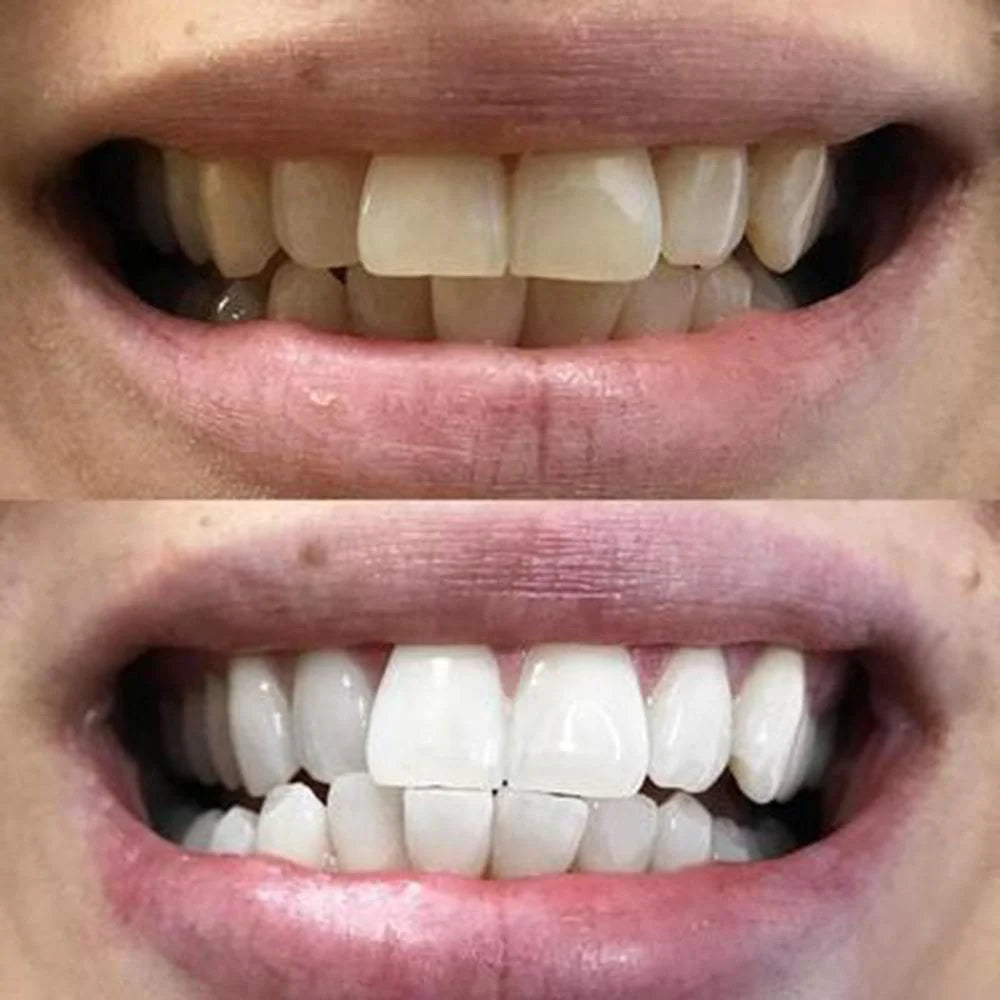 Bandes Blanchissantes pour Dents