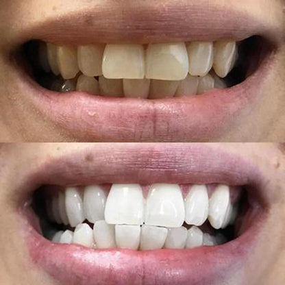 Bandes Blanchissantes pour Dents